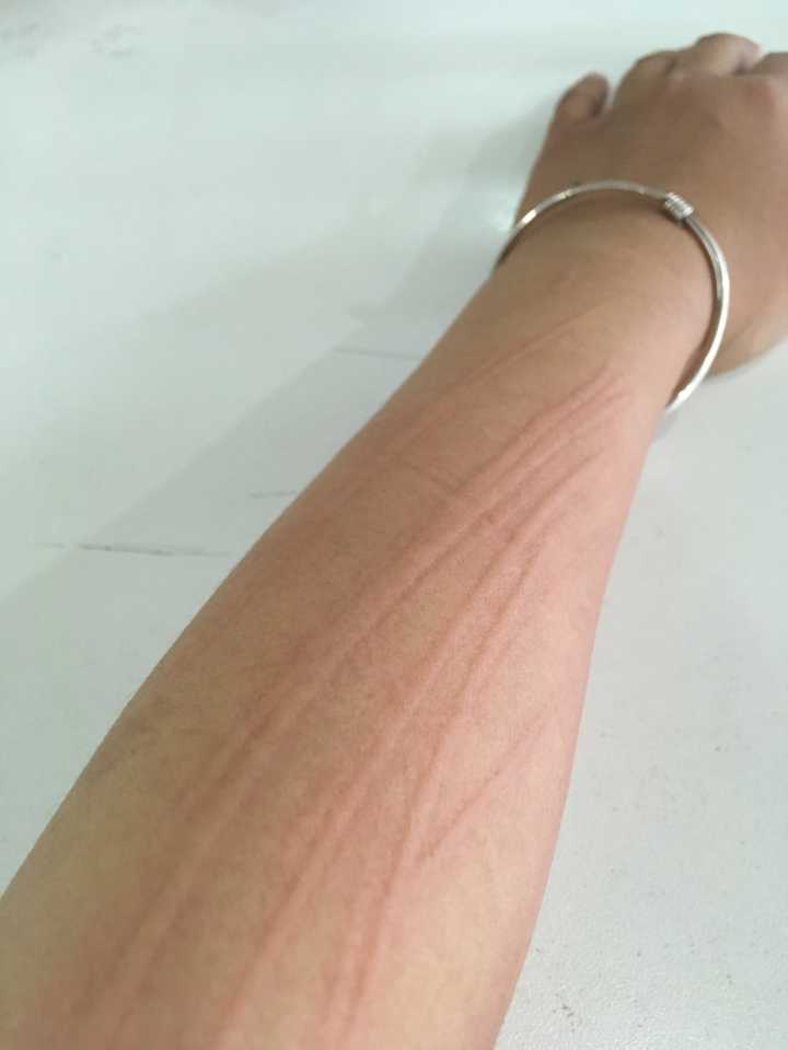 这种是人工*麻疹荨**，治疗人工*麻疹荨**记住这3点