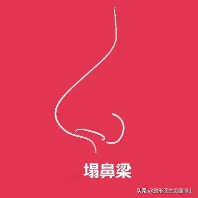 鼻整形如何一步到位,袁博整形医生