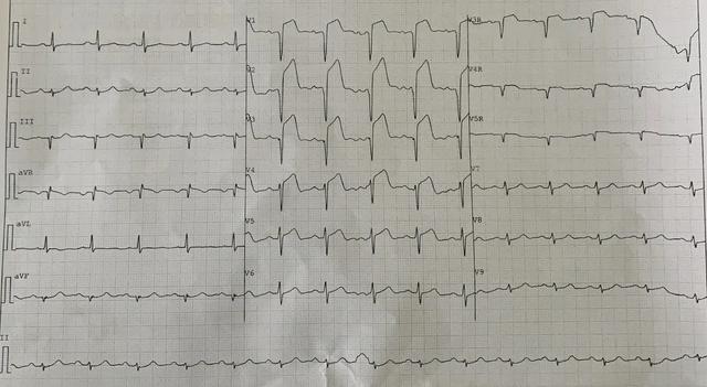 心肌梗塞医生不让马上手术,急救专家突发心肌梗塞