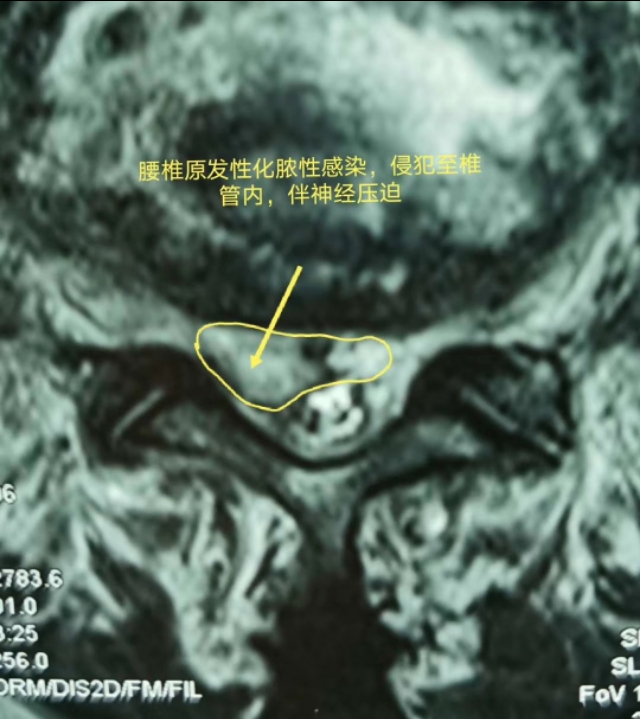 牙齿不好引发的疾病视频,牙齿有问题不做根管治疗会怎么样