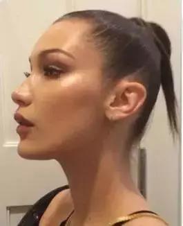 发际线后移的头发还能长出来么,头发发际线高还能长出来吗