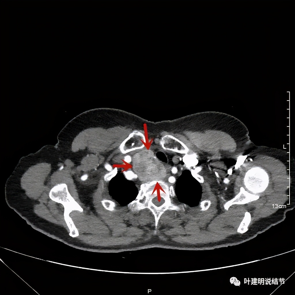胸部高分辨ct检查注意事项,胸部ct扫描有没有危害