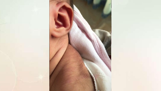 刚出生的婴儿背上长毛怎么回事,新生儿后背有黑色长毛