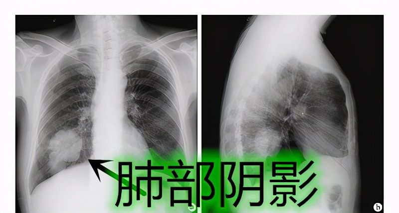 肺部结节高密度阴影是什么意思,肺部发现阴影需要做增强ct