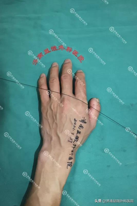 拇指缺失为什么影响这么大？手指再造中心如何找回缺失的手指？