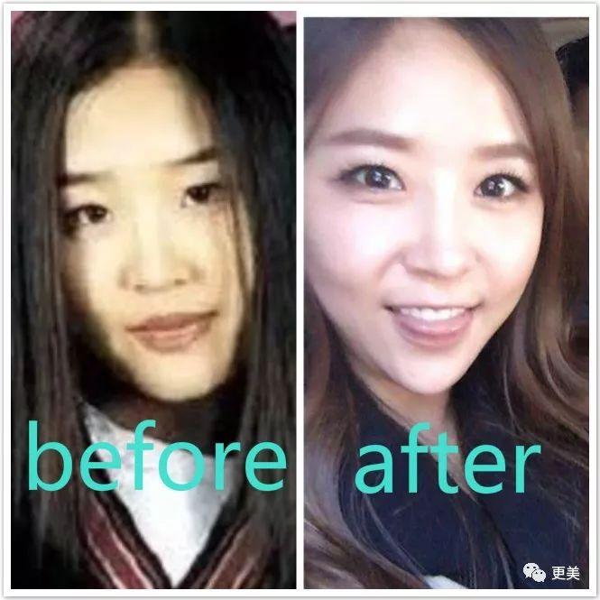 天后因队友吸du人气暴跌，公开承认整形却成蛇精下巴，瘦到脱相