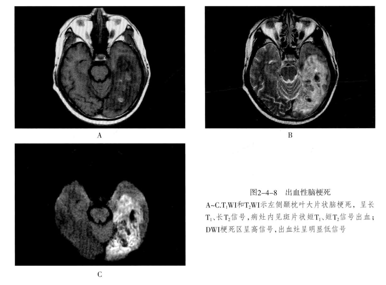 颅内血管轻度狭窄诊断标准,颅内血管先天变异影像