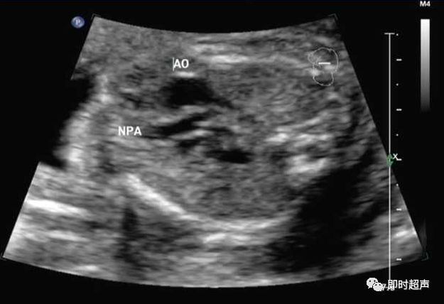 胎儿心脏三种血管关系模式图,25周的胎儿心脏弓切面多少正常