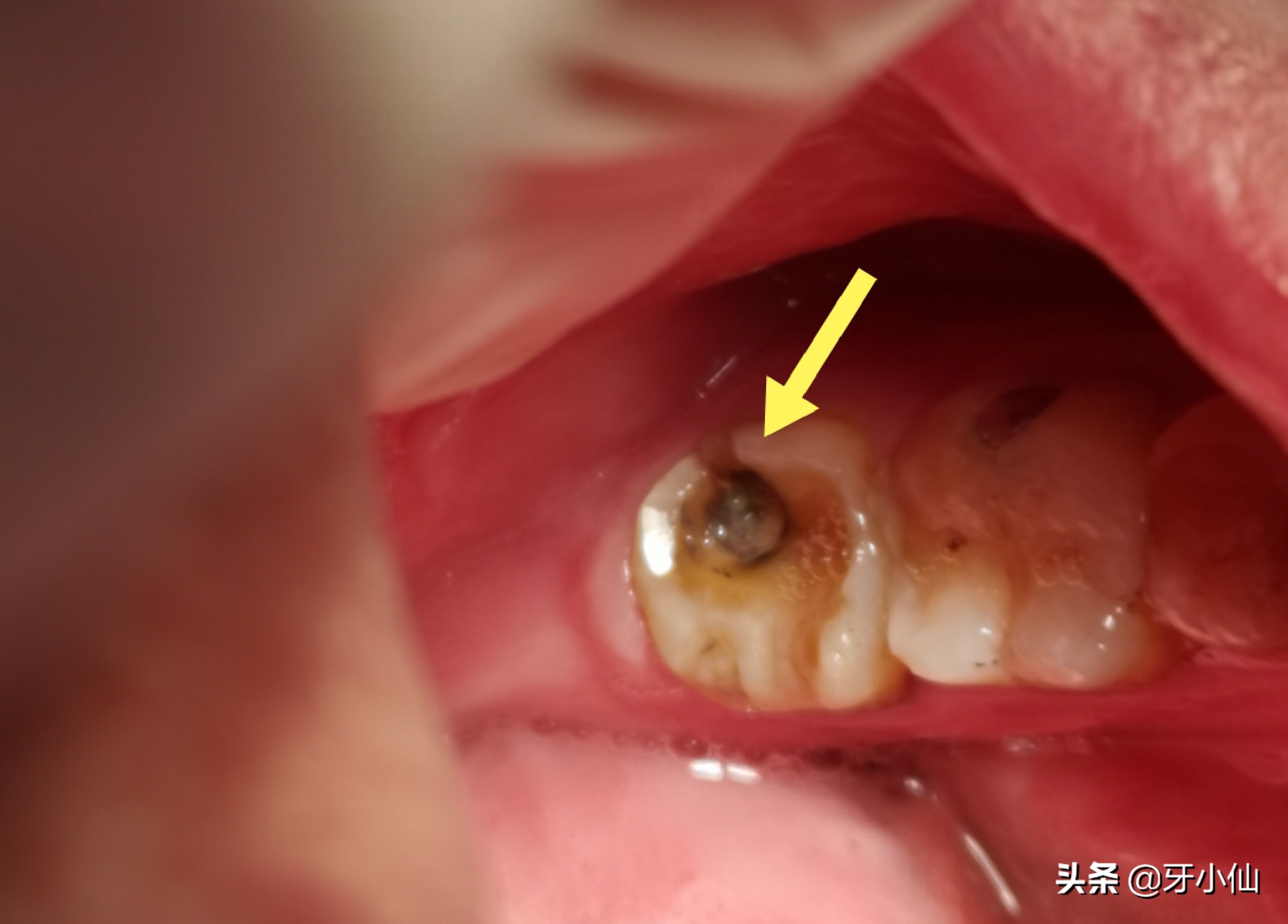 牙太痛,吃不了热辣火锅、冰爽雪糕、酸甜水果,怎么能当吃货?