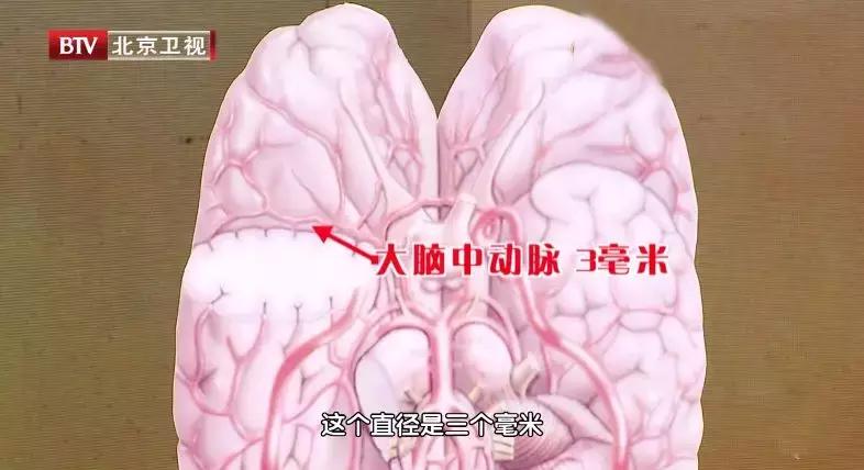 中风了一次为什么还会有第二次,脑中风二次犯病原因是肝不藏血吗