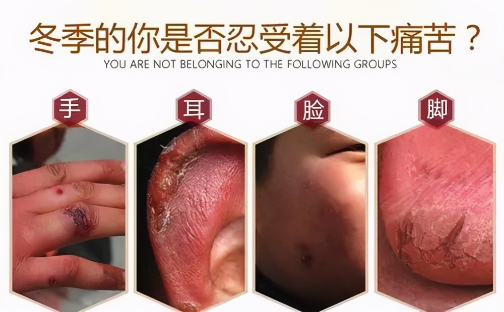 冻疮科普,冻疮从冷到长冻疮一般要多久