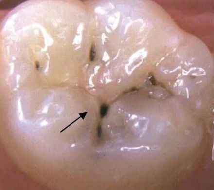蛀牙不是很严重需要补吗,蛀牙不严重要做根管治疗吗