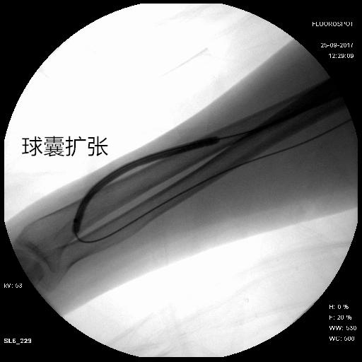 透析瘘口狭窄安支架能用多久,透析引起的上腔静脉狭窄怎么办