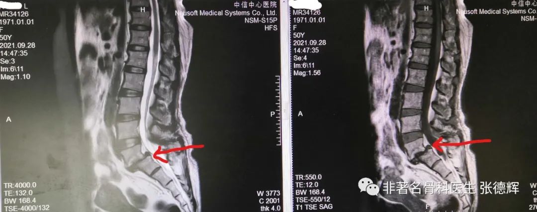 腰椎真性滑脱,手术复位融合固定