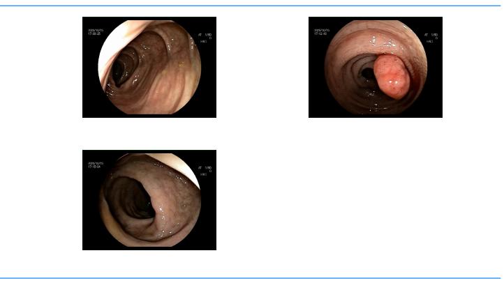 做了肠镜说是结肠息肉，怎么办？