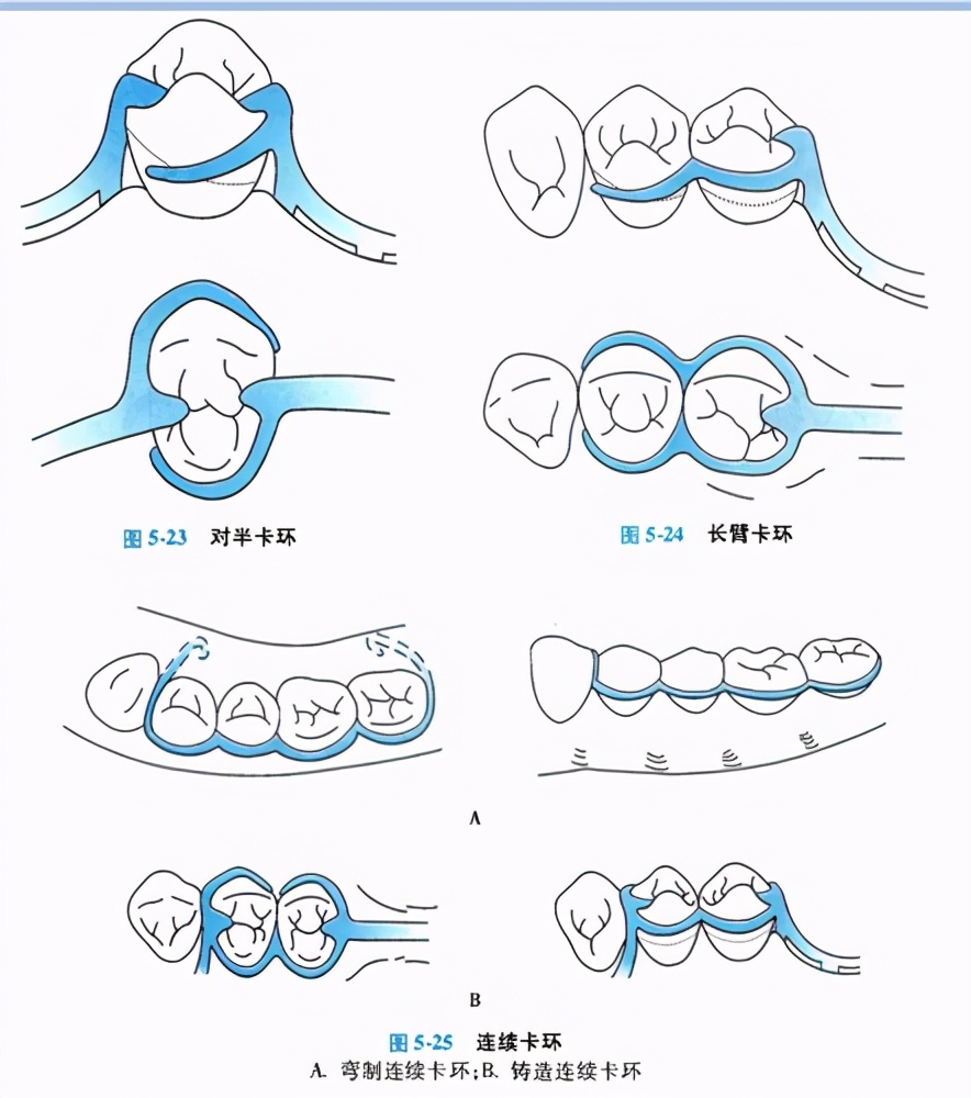 牙列缺损的可摘局部义齿修复题库,牙科美学修复精讲