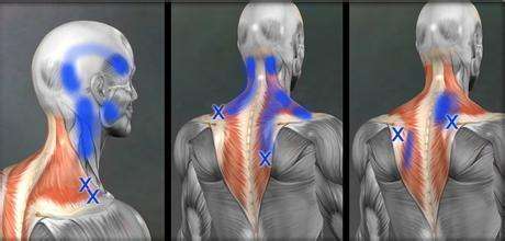 肌筋膜炎如何治疗,肌筋膜炎输液治疗能治愈吗