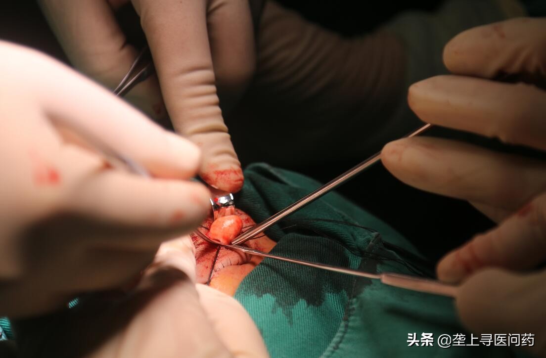 小孩眼睛长了良性肿瘤,孩子眼睛突然斜视会是大脑肿瘤吗