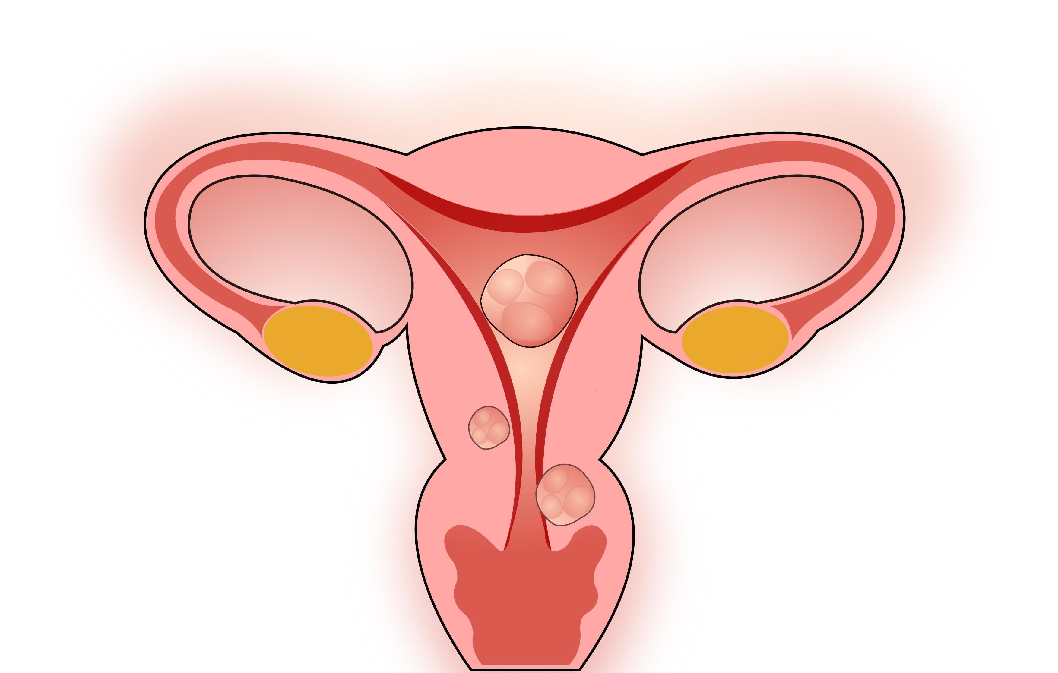 妇科恶性肿瘤严重威胁女性的健康,其发病与生殖道菌群的关系密切