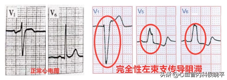 心脏完全性左束支传导阻滞危险吗,完全性左束支传导阻滞是心脏病吗