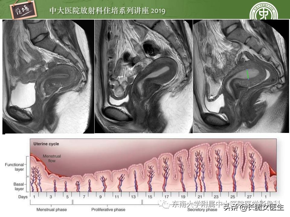 女性生殖子宫影像解剖及生理改变