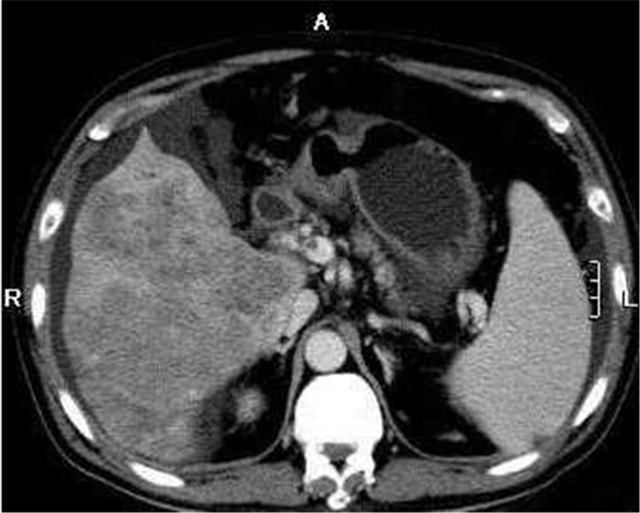 晚期肝癌常见的并发症,肝癌身体有什么预兆