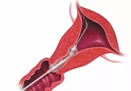 输卵管造影检查内幕揭秘,宫腔镜通液和输卵管造影哪个好