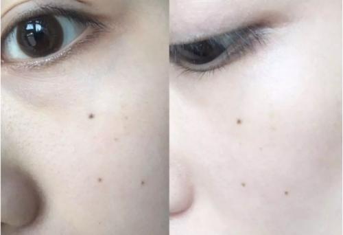 解决斑点问题，浪漫香榭丽我看行