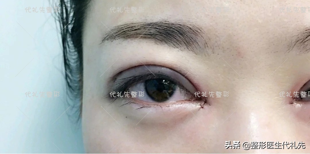 新月形双眼皮好看还是扇形好,新月型与平扇形双眼皮的区别