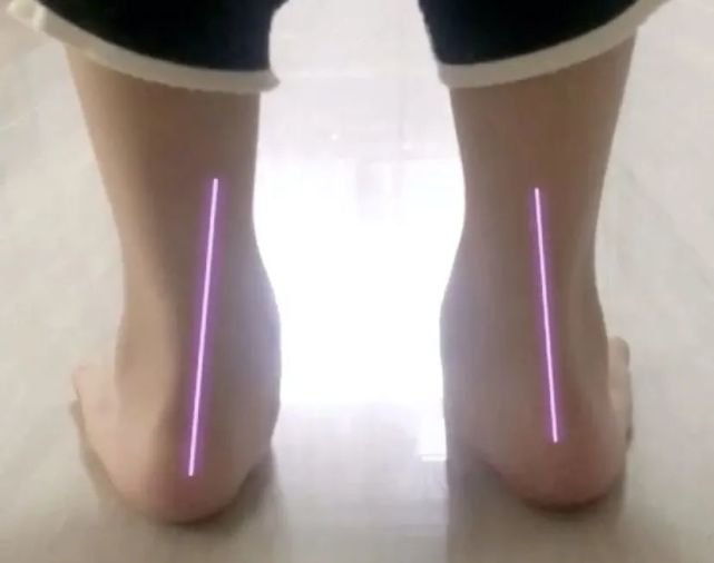 孩子走路“内八”or“外八”，可能和这3个小习惯有关