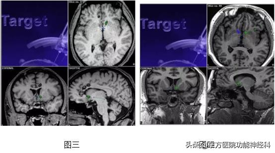 精神病人的前世,精神科药物的前世今生