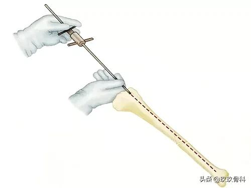 胫腓骨骨折髓内钉手术方式,髓内钉骨折最佳治疗方案