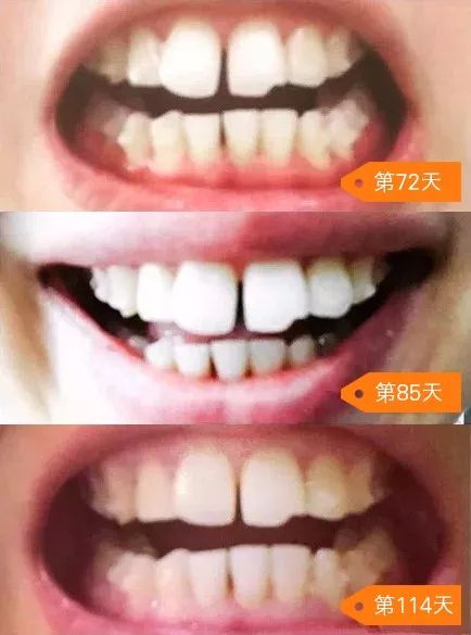 龅牙矫正前后对比照片,龅牙修复效果图