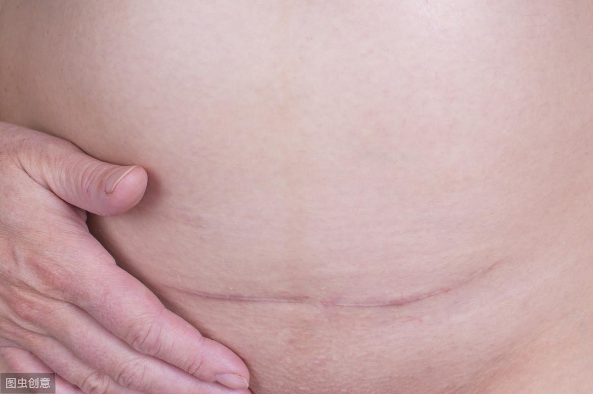 剖腹产对身体伤害大？几位宝妈的亲身经历告诉你有多扎心