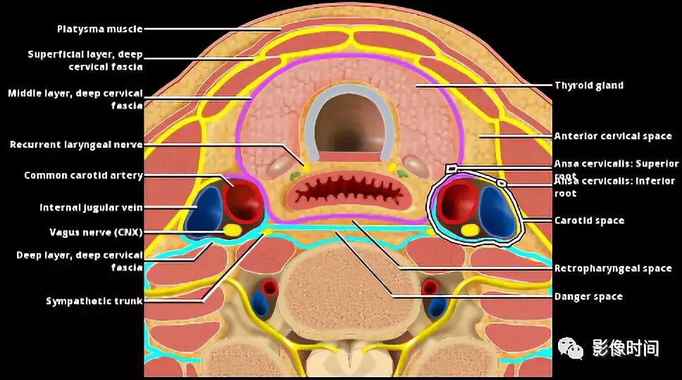 双侧颈动脉鞘间隙多发小淋巴结影,双侧颈动脉间隙多软组织密度结节