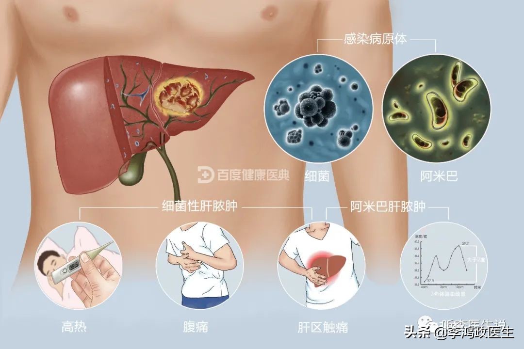 男子胃口差,治疗后左侧偏瘫,医生差点误诊,病因竟是肺脓肿