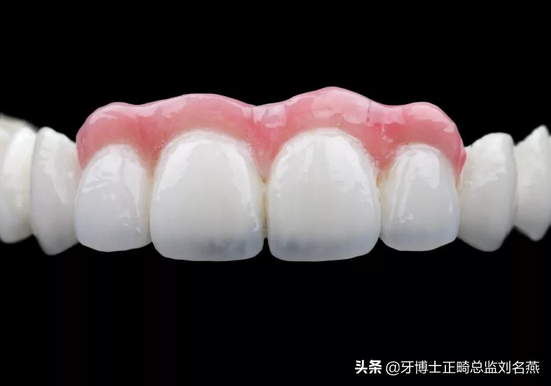 老人单颗缺牙修补多少钱,这3种缺牙修补方式你适合哪一种