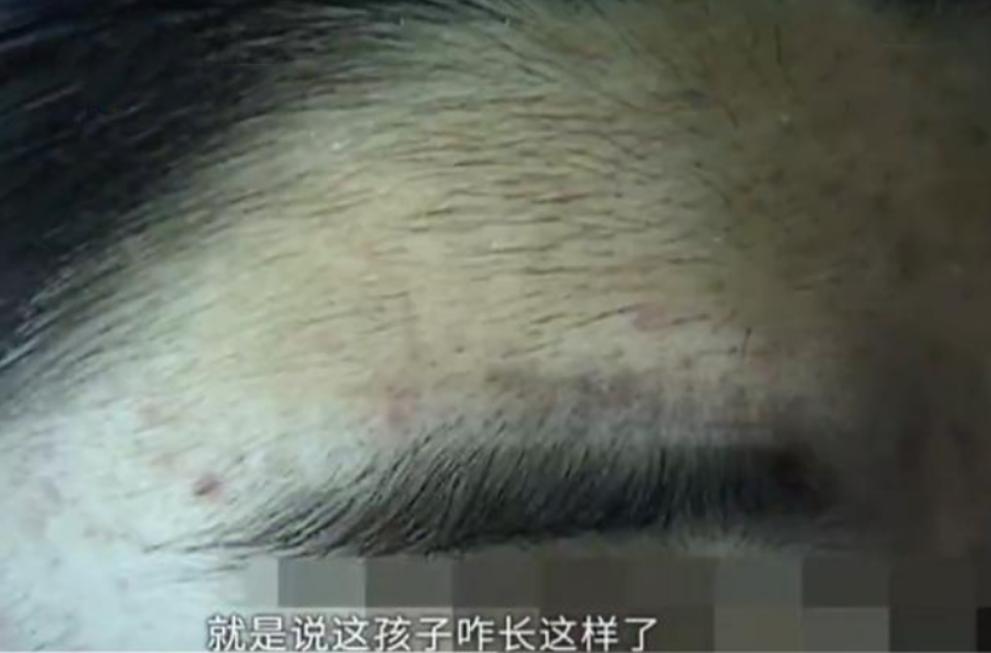 16岁姑娘做“脱毛项目”，没想到却越脱越多？母亲哭诉：像毛孩子