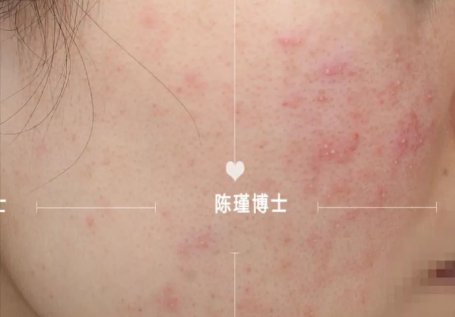 痘痘肌怎么刷酸效果好,痘痘肌刷酸的正确方法