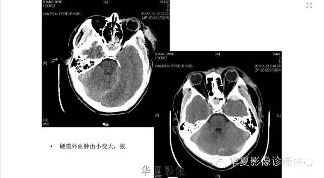 一文读懂颅内胆脂瘤,一文看懂背后的真相