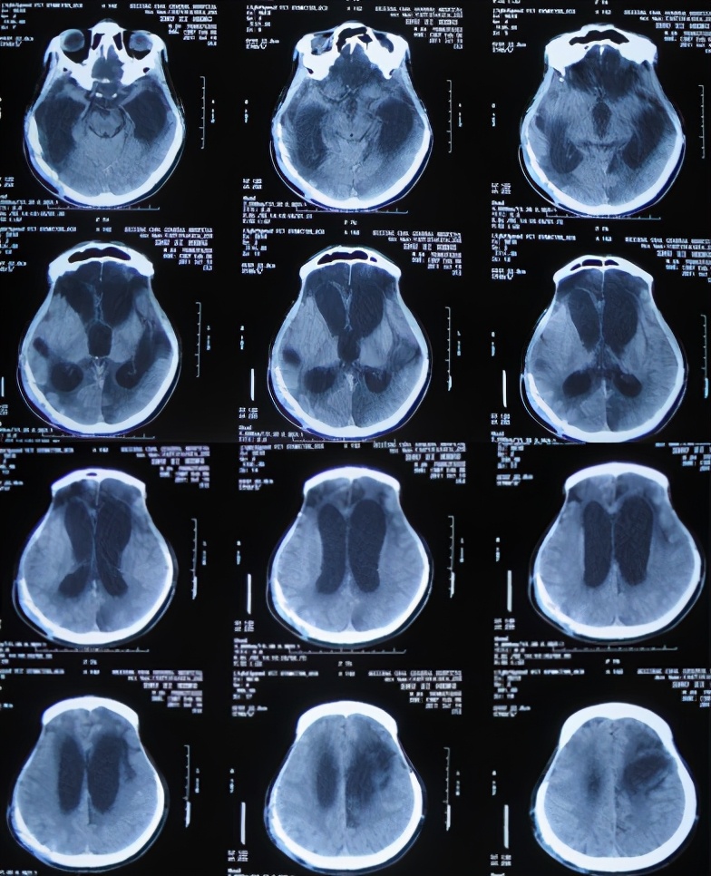 脑受伤开颅手术昏迷,开颅手术后20天发生脑积水引流