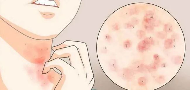 白疕的病因,白疕是什么临床特点