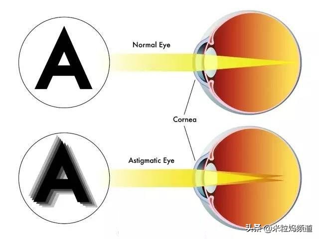 婴儿出生为什么是远视,小孩出生都是远视眼么