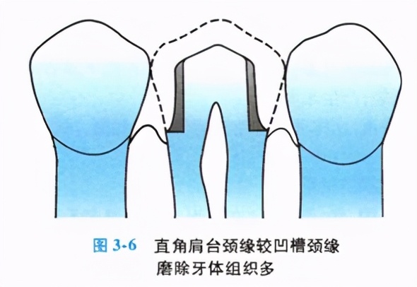 牙齿缺损修复去哪家牙科医院,牙科门牙缺损修复照片