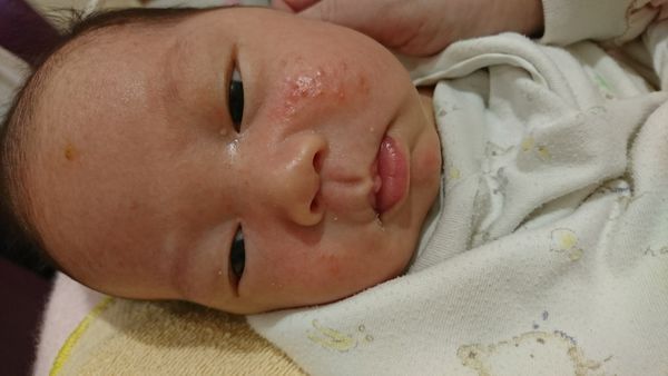 新生儿脂溢性皮炎怎么治疗最彻底,新生儿脂溢性皮炎用什么护理