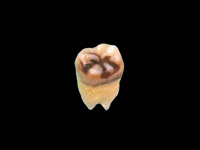 洗牙到底是伤害牙齿还是保护牙齿,洗牙对牙齿伤牙吗