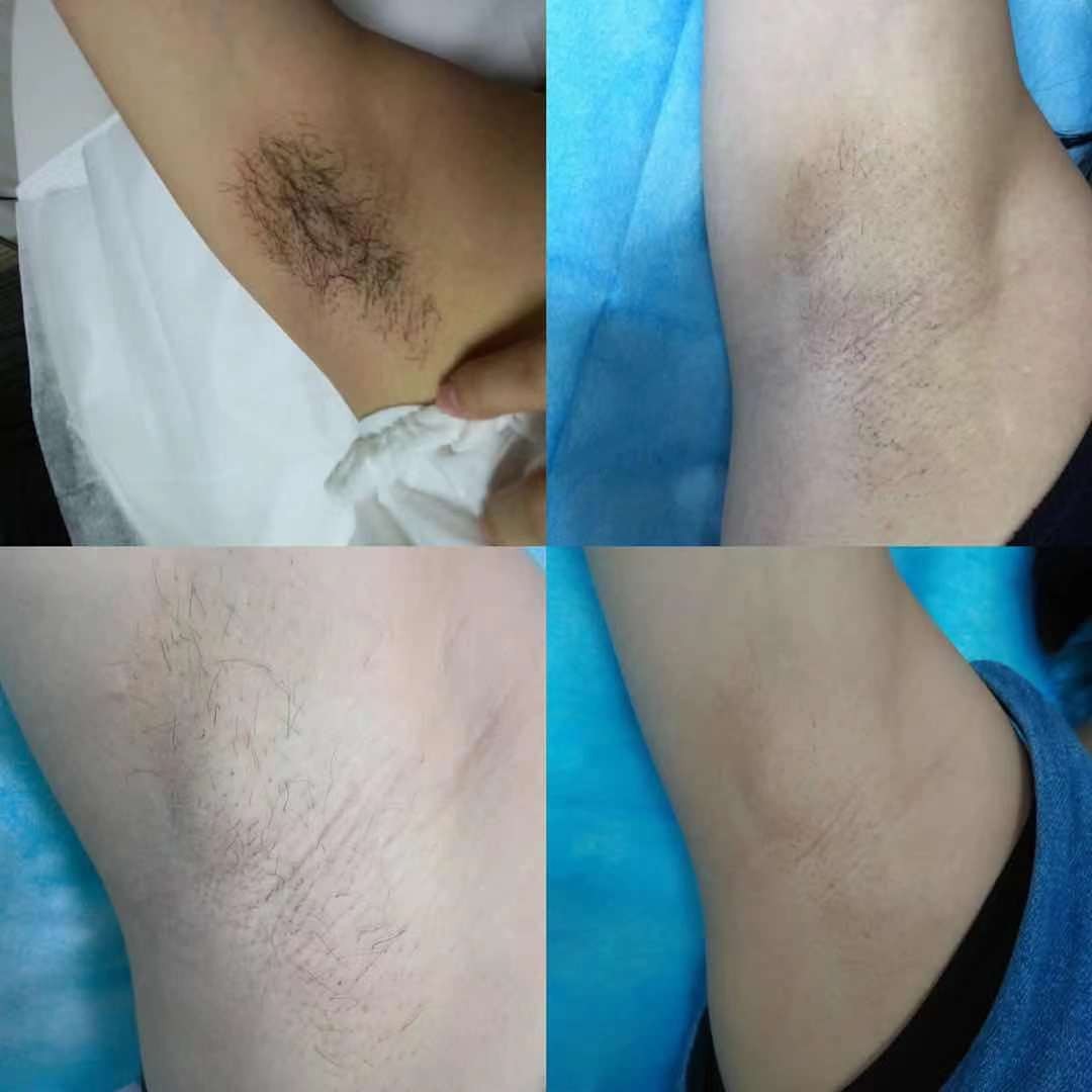 毛发脱毛,哪种脱毛才是永久性脱毛