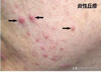 宅家的1个多月都没化妆，竟然还爆痘