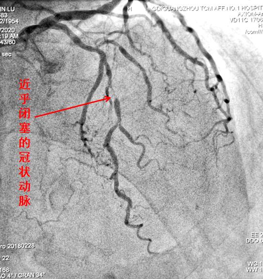 心肌缺血心肌梗死怎么检查,心肌梗死怎么样急救