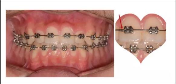 牙齿矫正有几种方式,牙齿矫正刷牙方式视频